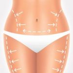 Everything About Liposuction Surgery